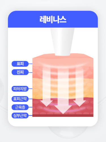 레비나스 충격파 침투 깊이 표피 진피 근막